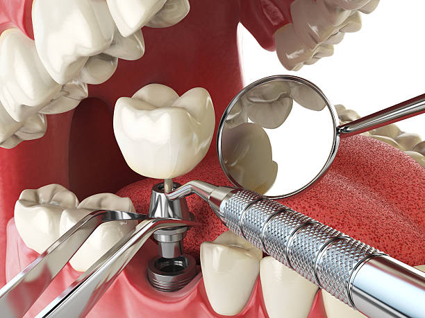 Best Dental Abscess Treatment in Orland Hls, IL